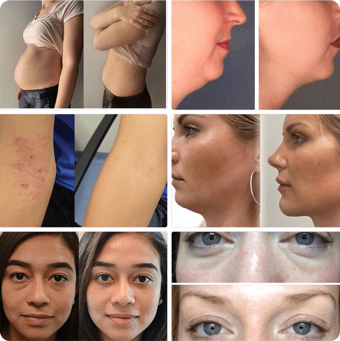 LymphaCore transformation before/after